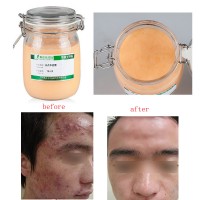 Face Care Acne Scar Removal Cream Acne Spots Skin Care Treatment Stretch Marks Oil Care Anti Acne Cream